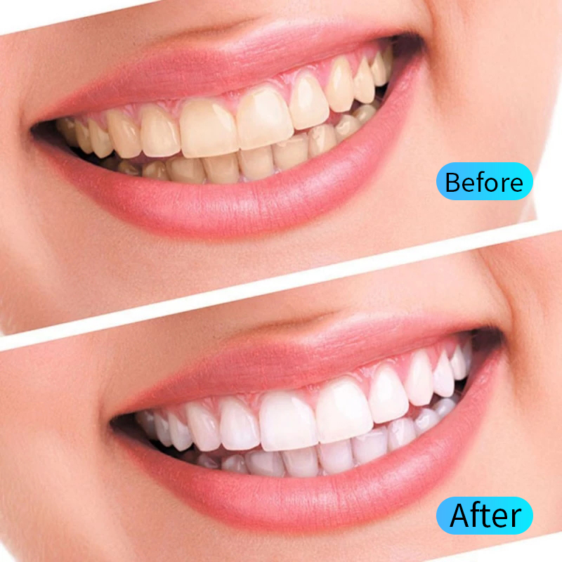 Teeth Whitening Gel Kit Oral H - Teeth Whitening Filter 评论和价格