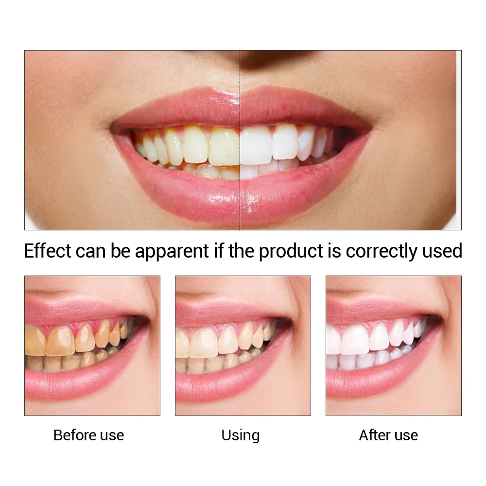 FTEENPLY Teeth Whitening Essen - Teeth Whitening From Home 评论和价格