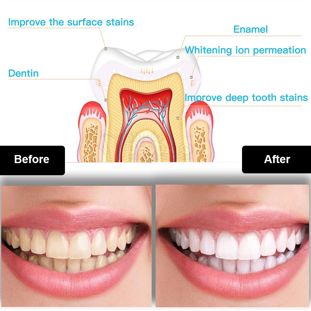 Dental Teeth Whitening Kit Min - Teeth Whitening From Home 评论和价格