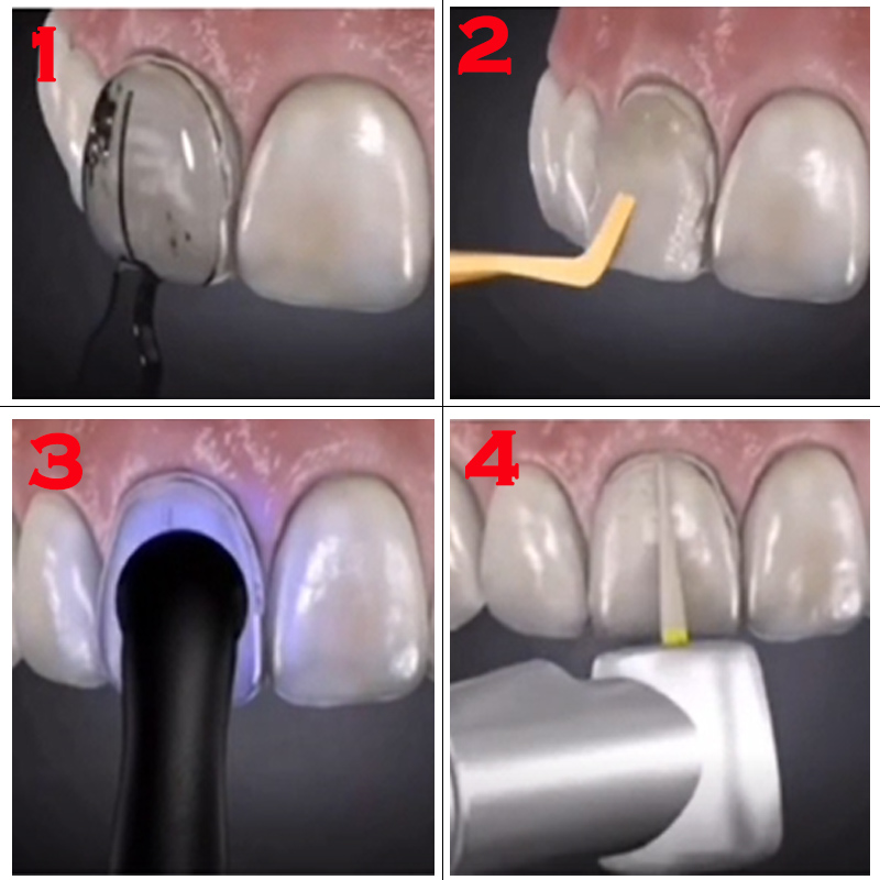 32pcs Dental Veneer Mould Kit  - Teeth Whitening Light Kit 评论和价格